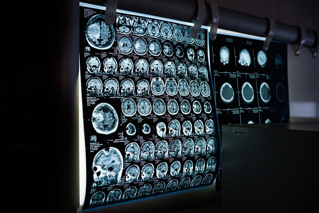 뇌 MRI 검사