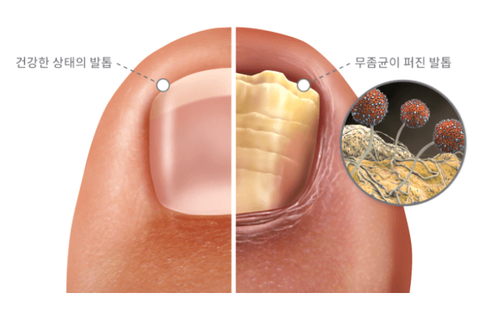 무좀 균이 퍼진 발톱