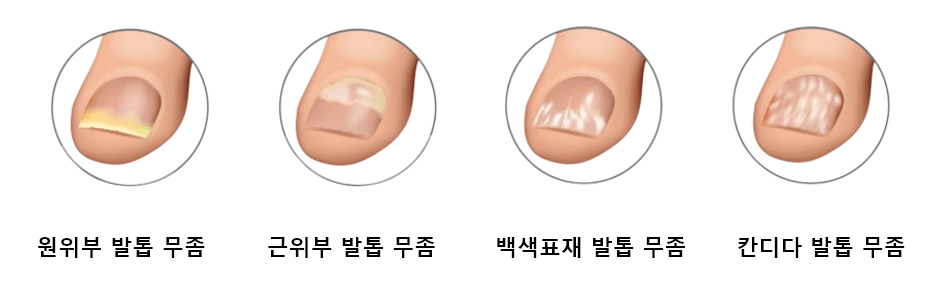 발톱 무좀 종류